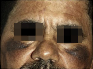 Paciente em uso de hidroquinona com mácula acinzentada na proeminência malar e acastanhada nas regiões frontal, malar e nasal.