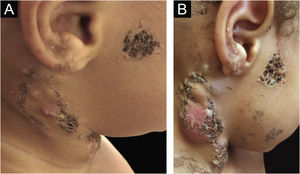 (A) Placas encimadas por agrupamento de comedões, com pequena área eritematosa e formação de cistos na região cervical lateral direita. (B) Mesma lesão com piora do quadro inflamatório.