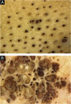 Dermatoscopia: aberturas foliculares dilatadas com tampões ceratóticos agrupados.