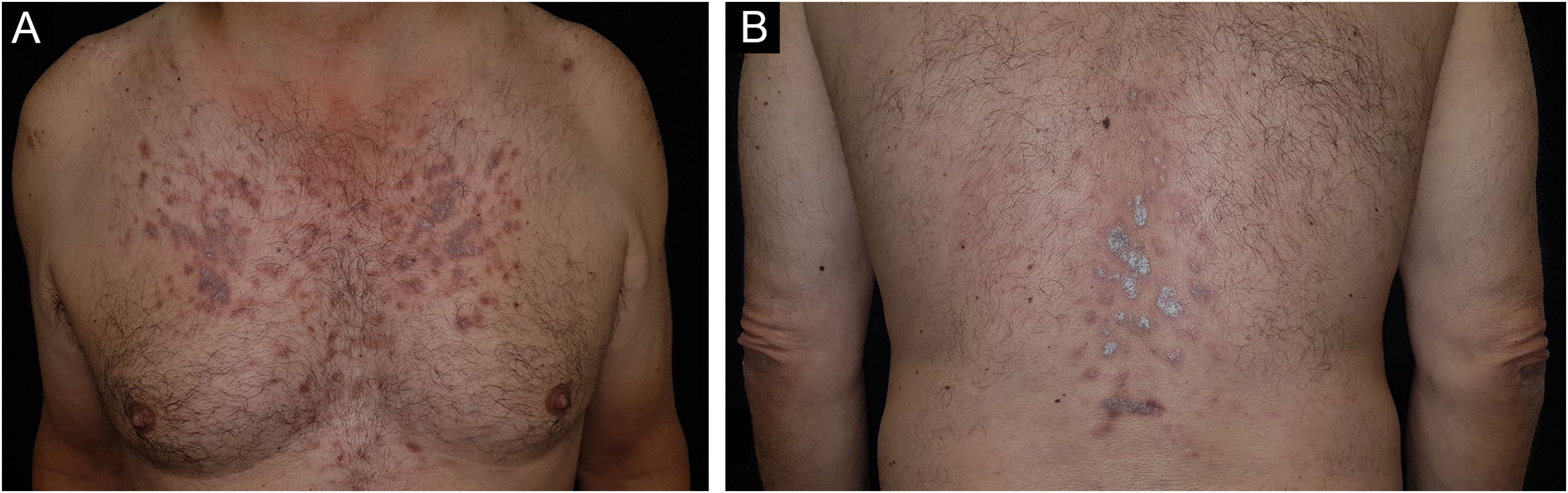 Rosuvastatin Rxn Rash Erupção medicamentosa liquenoide induzida por pravastatina. É possível ...