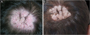 (a) Placa vegetante alopécica com eritema, erosões e crostas. (b) Placa verrucosa alopécica cicatricial no vértice à direita após remissão da doença.