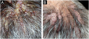(a) Placas vegetantes no couro cabeludo com exsudação, crostas, erosões e fissuras. (b) Placas verrucosas lobuladas nos vértices à direita e à esquerda no couro cabeludo após remissão da doença.