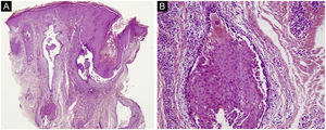 (a) Visão panorâmica da biópsia revela clivagem acantolítica suprabasal extensa em quase todos os folículos pilosos (Hematoxilina & eosina, 40×). (b) Detalhe em grande aumento da acantólise suprabasal no epitélio folicular, altamente sugestiva de pênfigo (Hematoxilina & eosina, 200×).