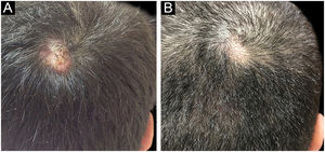 (a) A biópsia mostra epiderme acantótica, clivagem suprabasal na epiderme e em todos os folículos pilosos (Hematoxilina & eosina, 40×). (b) Epiderme e epitélio do folículo piloso mostrando acantólise suprabasal, infiltrado inflamatório rico em plasmócitos na derme circundante (Hematoxilina & eosina, 200×).