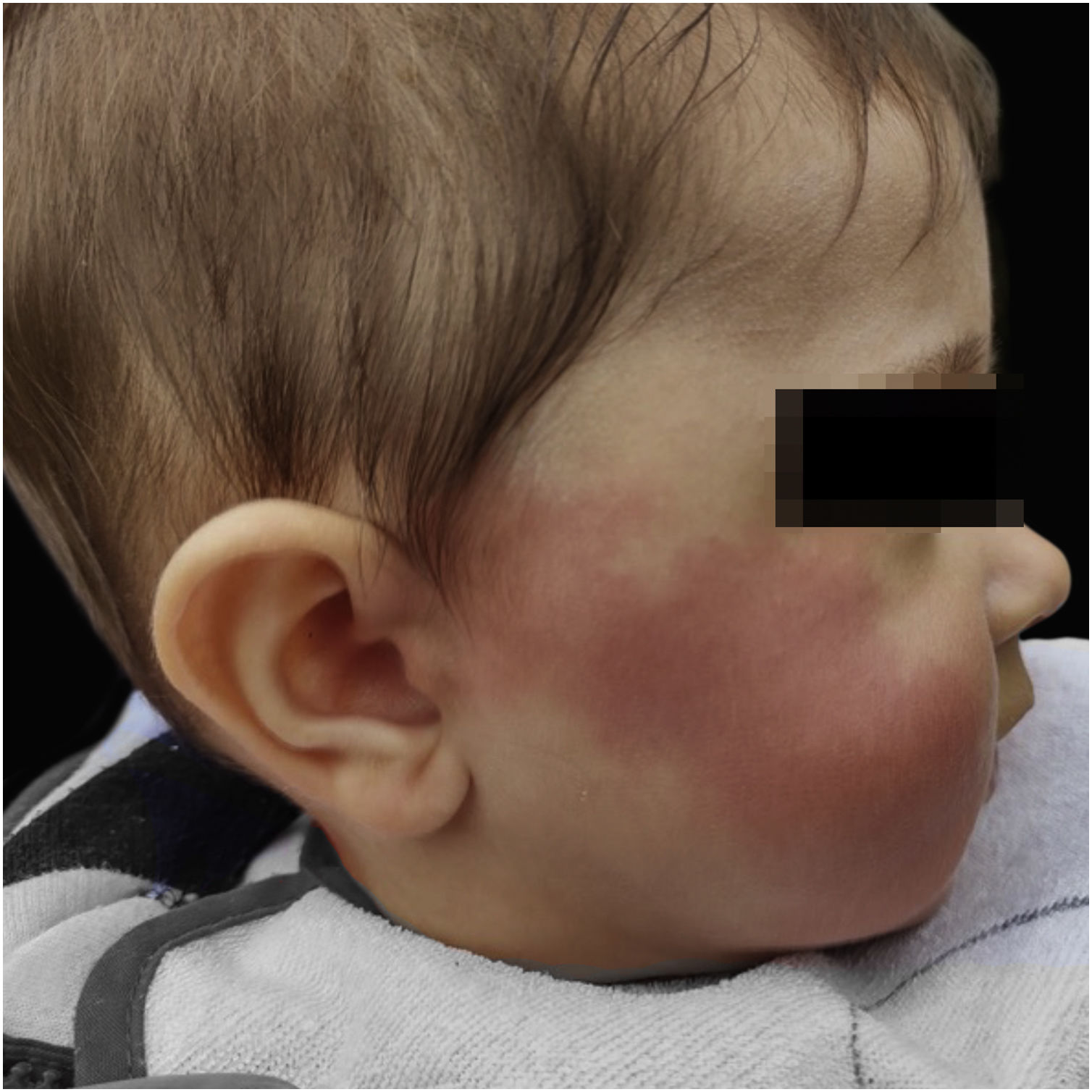 Unilateral Rash Caso para diagnóstico. Rash unilateral transitório na face durante a ...