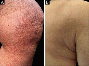 (a) Placas eritêmato‐acastanhadas finamente descamativas e de aspecto apergaminhado no terço distal da coxa e joelho esquerdos; e (b) na região escapular direita, após dois meses.