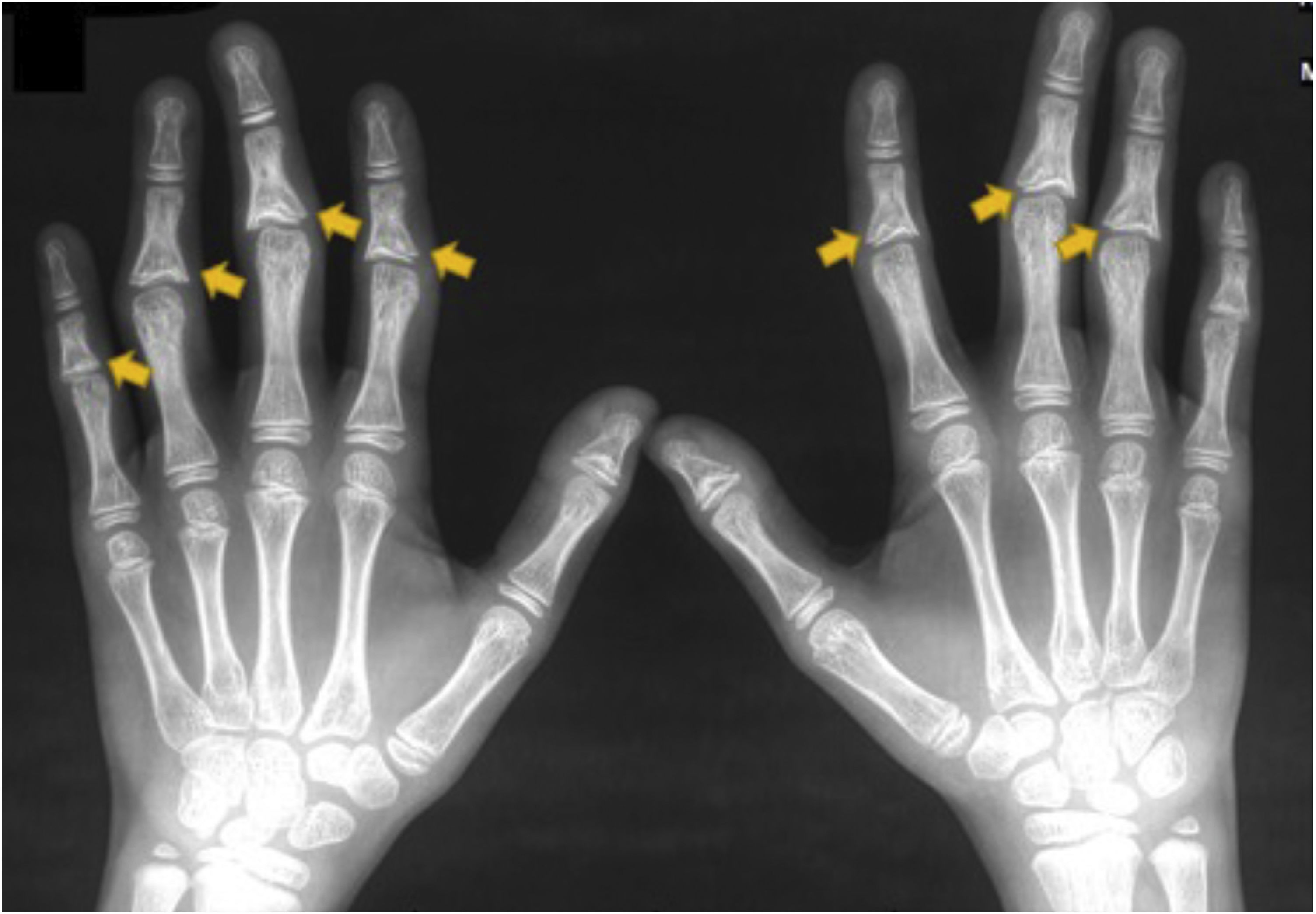 Falanges Rx Síndrome trico‐rino‐falangiana | Anais Brasileiros de Dermatologia ...