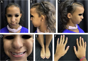 Características fenotípicas da paciente. (A e D) Nariz em pera, (B e C) rarefacão capilar difusa, mais intensa nas regiões frontotemporais, (E e F) deformidades articulares nos pés e mãos.