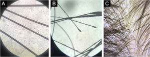 Tricograma. (A) Análise tricoscópica na microscopia óptica. Revela hastes capilares de aspecto normal. (B) No maior aumento, revelam fios telógenos normais. (C) Tricoscopia normal, porém com fios finos, correspondendo à hipotricose.