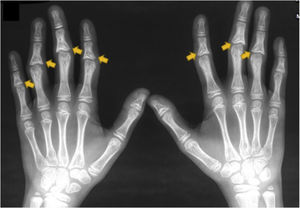 Radiografia de mãos com epífises em cone nas falanges médias (setas em amarelo).