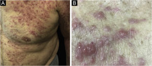 Leucemia cútis em doente com LMA. (A) Múltiplas pápulas e nódulos eritematosos, infiltrados, de superfície lisa acometendo tronco e membro superior. (B) Lesões em maior aumento.