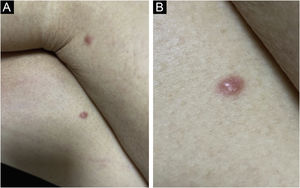 Leucemia cútis em doente com LMA. (A) Recidiva pós‐TMO alogênico ‐ duas pápulas isoladas eritematosas, lisas, de consistência endurecida em ambas as coxas. (B) Detalhe da lesão em maior aumento.