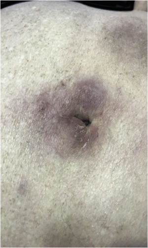 Plasmocitoma cutâneo. Nódulos eritemato‐violáceos, mal delimitados e infiltrados na região periumbilical.