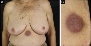 Linfoma folicular cutâneo secundário. (A) Tumoração subcutânea eritemato‐acastanhada infiltrada com telangiectasias na região epigástrica. (B) Lesão em maior aumento.