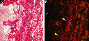 Síndrome do nevo displásico: nevo displásico clássico ‐ à esquerda, a epiderme (E) mostra agregados de melanócitos na junção dermoepidérmica (setas amarelas) e, à direita, a derme papilar sob o nevo é indicada por setas azuis. Aumento original, 400×. Vermelho de picrosirius, sem polarização (A) e sob polarização (B).
