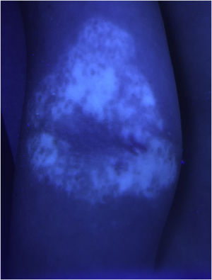 Exame com lâmpada de Wood em máculas hipopigmentadas das fossas antecubitais no Caso 1, confirmando diagnóstico de vitiligo.