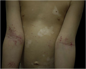 Lesões eczematosas em áreas corporais típicas de DA, juntamente com vitiligo no tronco.