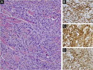 (A) Maciços de células atípicas e pleomórficas com numerosas mitoses e áreas necróticas. As células tumorais apresentam nucléolo proeminente, citoplasma excêntrico com desproporção núcleo/citoplasma. As células tumorais são imunorreativas com (B) CD163 (400×), (C), lisozima (400×) e (D) CD68 (400×).