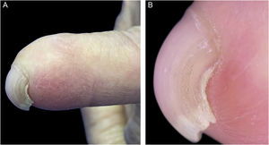 (A) Deformidade tipo UBP da unha do quinto quirodáctilo esquerdo. (B) A dermatoscopia melhor observação da característica curvatura da lâmina ungueal.