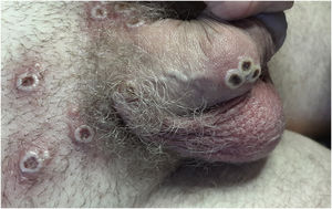 Múltiplas lesões crostosas na região genital.