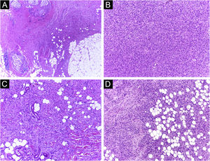 Dermatofibrossarcoma protuberante (parafina, H&E). (A) Neoplasia recidivada invadindo a hipoderme à direita da imagem e, à esquerda, área de fibrose cicatricial com reação a corpo estranho, secundários à cirurgia convencional prévia. (B) Área sólida de padrão estoriforme. (C e D) Periferia infiltrativa da neoplasia, com fascículos de células fusiformes monomórficas invadindo tecido fibroconjuntivo à esquerda, e tecido adiposo em ambas. Fonte: Arquivos Dermatologia/Anatomia patológica HC‐Unicamp.