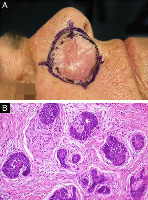 Tricoblastoma recidivado. (A) Delimitação clínica durante a CMM. (B) Proliferação das células germinativas foliculares, ilhotas de células basaloides e estroma fibrocelular (parafina, H&E). Fonte: Arquivos Dermatologia HC‐Unicamp.