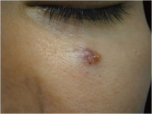Lesão nodular de cerca de 1,5cm infrapalpebral E com diagnóstico de adenocarcinoma primário cutâneo. Fonte: Arquivos Dermatologia HC‐Unicamp.
