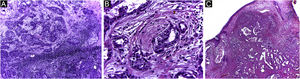 Adenocarcinoma primário cutâneo (H&E). (A) Cortes de 5 micra de espessura em congelação, exibindo estruturas glandulares infiltrando a derme reticular, associada a inflamação crônica. (B) Em parafina, exibindo infiltração neoplásica perineural. (C) Em parafina, panorâmica exibindo tumor mal circunscrito, constituído por estruturas glandulares irregulares invadindo a derme. Fonte: Arquivos Dermatologia/Anatomia patológica HC‐Unicamp.