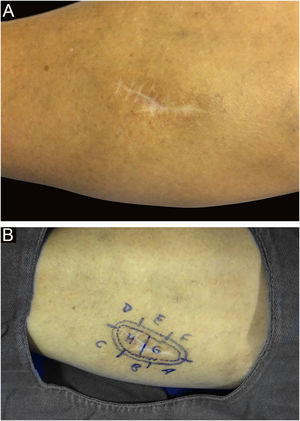 (A) Cicatriz na perna direita secundária à cirurgia convencional prévia. (B) Delimitação clínica de espiradenoma recidivado durante a CMM. Fonte: Arquivos Dermatologia/HC‐Unicamp.