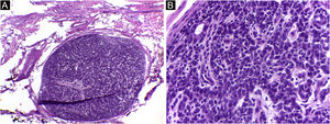 Espiradenoma (cortes de 5 micra de espessura em congelação corados com H&E). (A) Padrão multinodular, com nódulos circunscritos relativamente grandes posicionados dentro da derme e subcutâneo. (B) As células basaloides são de dois tipos. Na periferia, são pequenas com núcleo hipercrômico, e no centro ou em torno de pequenos lumens, são maiores com núcleo pálido. Fonte: Arquivos Dermatologia/Anatomia patológica HC‐Unicamp.