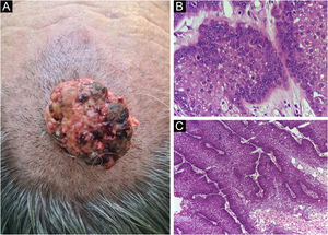 (A) Carcinoma sebáceo extraocular. (B) Lóbulos pouco definidos de células basaloides e células sebáceas pouco desenvolvidas (corte de parafina, H&E). Atipia moderada. (C) Debulking tumoral durante cirurgia micrográfica de Mohs (corte de congelação de 5 micra de espessura, H&E). Fonte: Arquivos Dermatologia/HC‐Unicamp.