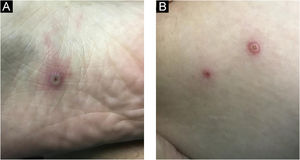 Lesões vesiculopustulares com ulceração central na superfície plantar (A) e coxa (B).