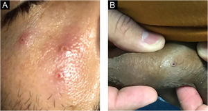 Lesões vesiculopustulares típicas da Mpox com ulceração central na face (A) e pênis (B).