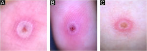 Imagens dermatoscópicas de Mpox mostrando área central ulcerada rósea ou crostosa acastanhada, com halo periférico branco e eritema perilesional na superfície plantar (A), dedo indicador (B) e coxa (C).