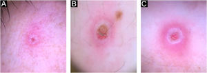 Características dermatoscópicas das lesões de Mpox: centro sem estrutura róseo ou com área crostosa de cor castanha, com halo periférico branco, circundado por massas ou aglomerados róseos e eritema perilesional, na face (A), pênis (B) e região perianal (C).