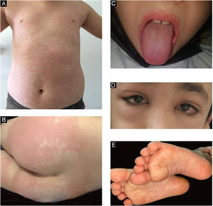 (a) Erupção maculopapular no tronco. (b) Placa urticariforme eritematosa na região glútea. (c) Língua em morango. (d) Edema periorbital e hiperemia conjuntival. (e) Máculas eritematosas plantares bilaterais.