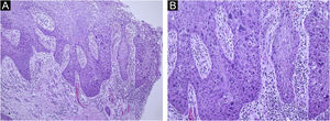 (A) Histopatologia mostrando acantose irregular e displasia epidérmica de espessura total, sem infiltração de células atípicas na derme (coloração de Hematoxilina & eosina, ampliação original 100×). (B) Células epidérmicas com núcleos hipercromáticos, atipias e numerosas mitoses (Hematoxilina & eosina, 200×).