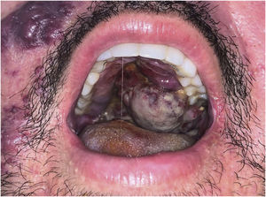 Tumoração violácea, infiltrada, com áreas de leucoplasia no palato.