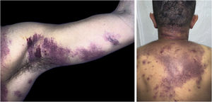 Lesões purpúricas, pápulas, nódulos e tumores violáceos na axila, membro superior, região cervical e tronco, de tamanhos variados, indolores.