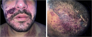 Pápulas, nódulos e tumores violáceos na face e couro cabeludo, de tamanhos variados, indolores.