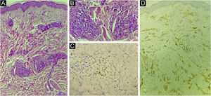 (A) Proliferação vascular atípica, com vasos irregulares e atipias endoteliais (Hematoxilina & eosina). (B) Foto A em maior aumento (Hematoxilina & eosina, 100×). (C) Imuno‐histoquímica de fragmento cutâneo evidenciando positividade para o herpes‐vírus humano 8 (HHV 8). (D) Imuno‐histoquímica de fragmento cutâneo demonstrando positividade para o marcador de células endoteliais CD31.