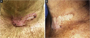 (A) Placa cicatricial inestética com bordas hiperceratóticas após tratamento para esporotricose. (B) Lesão residual após quatro sessões de crioterapia.