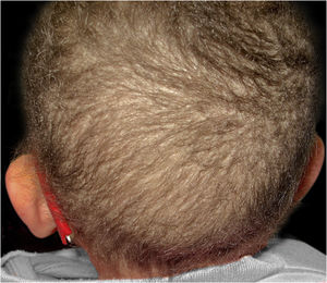 Cabelo curto e quebradiço, em diferentes comprimentos.