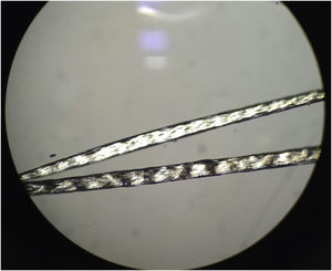 Exame do cabelo ao microscópio com luz polarizada: tricosquise com típico “padrão em cauda‐de‐tigre”. Observar a alternância de faixas transversais claras e escuras.