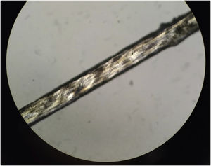 Haste de cabelo irregular e ondulada ao exame com luz polarizada e microscopia óptica.