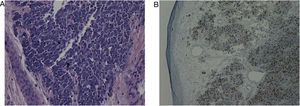 Aspecto histopatológico típico do carcinoma de células de Merkel. (A), Grandes aglomerados de células basaloides na derme e tecido subcutâneo com focos de necrose. As células tumorais formam cordões anastomosados em padrão trabecular atingindo derme reticular profunda (Hematoxilina & eosina, 40×). (B) Imunomarcação com CK‐20 no carcinoma de células de Merkel mostra padrão paranuclearpontilhado (dot‐like) (CK‐20, 40×).
