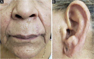 Comedos abertos e cicatrizes acneiformes na região supralabial, mento e pré‐auricular, após tratamento.