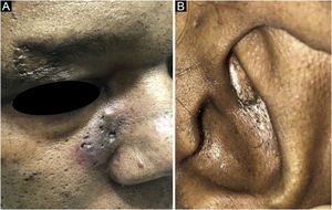 Placa eritematosa e hipercrômica com comedos nas regiões paranasal, malar, superciliar (A) e auricular (B).