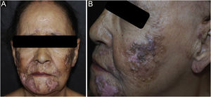 Comedos abertos e fechados sobre placas de lúpus eritematoso discoide em atividade. (A) Distribuição das placas na face. (B) Detalhe da lesão.
