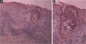 (A) Corte histológico mostrando hiperceratose, atrofia da epiderme, degeneração vacuolar da camada basal e grande tampão córneo folicular; na derme, infiltrado mononuclear superficial e profundo, perianexial e perivascular (Hematoxilina & eosina, 40×). (B) Detalhe do tampão córneo obstruindo um folículo piloso dilatado. Observar a degeneração vacuolar da parede do folículo e epiderme adjacente (Hematoxilina & eosina, 100×).